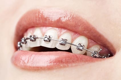 dental braces