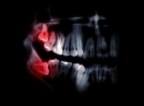 Risks and Rewards from Wisdom Tooth Removal