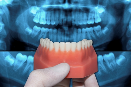 Understanding Dental “Lingo”